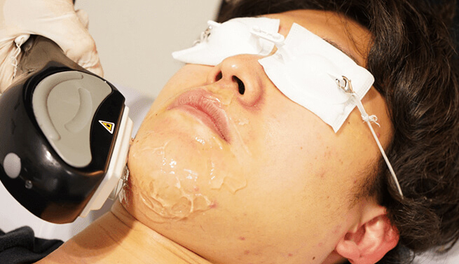 HAIR REMOVAL
